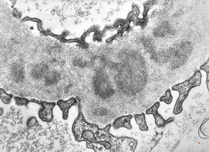 membranoproliferative glomerulonephritis